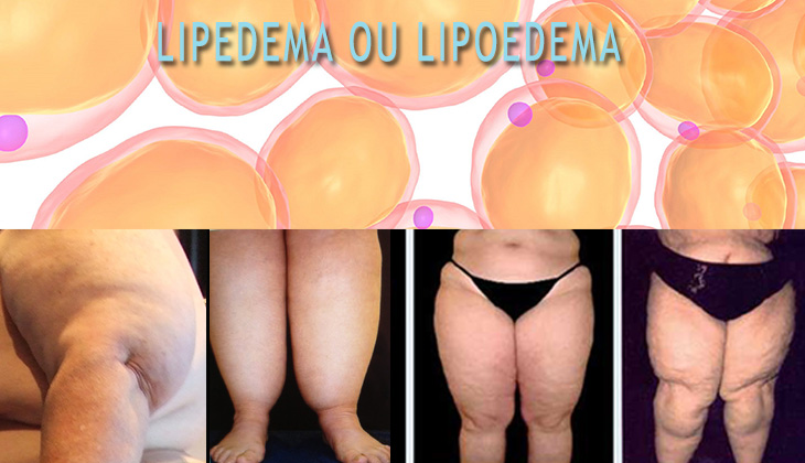 lipedema ou lipoedema