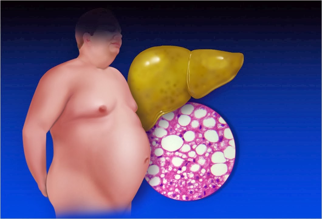 esteatose - gordura no fígado, síndrome metabólica