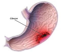 Tratamento para cancer no estomago